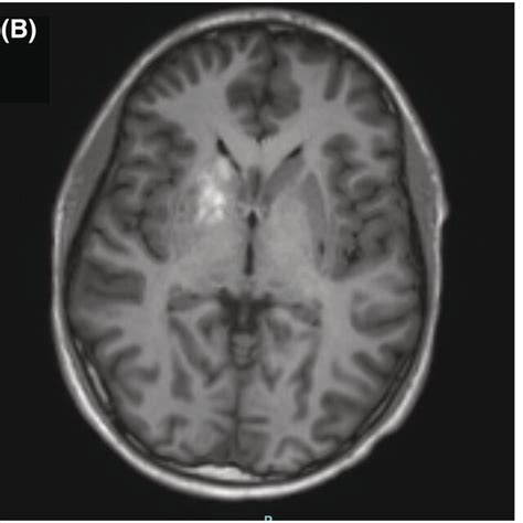 (PDF) Nonketotic hyperglycemic hemichorea‐hemiballismus in a pediatric ...