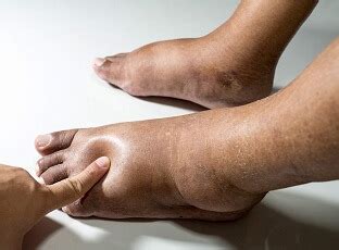 Trench Foot: Causes & Treatment For Immersion Foot