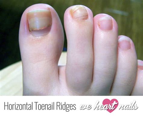 Horizontal Ridges on Toenails | Effective Treatments 2020