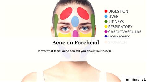 Forehead Acne: Causes and Treatment – Minimalist