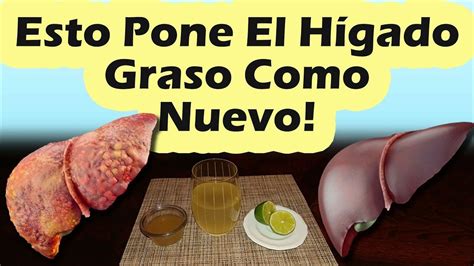 ESTO PONE EL HIGADO GRASO COMO NUEVO - Como Curar El Higado Graso Con Remedios Caseros - YouTube ...