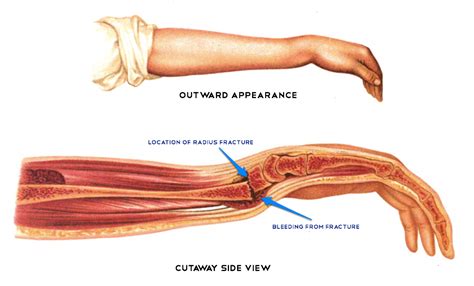 Wrist Fractures