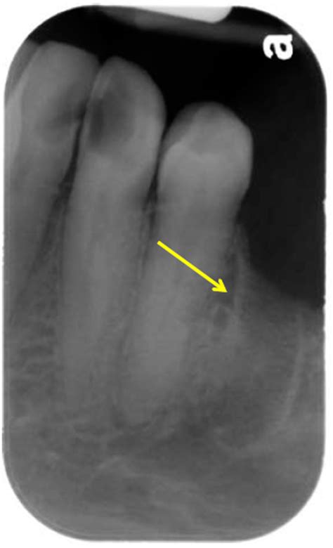 Remnant Lamina Dura – Dr. G's Toothpix