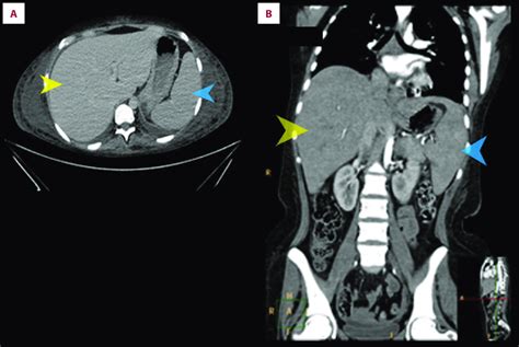 (A) Axial abdominal CT scan showing enlarged spleen (blue arrow) and ...