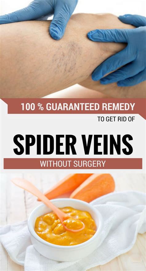 100 % Guaranteed Remedy To Get Rid Of Spider Veins Without Surgery | Wellness Right