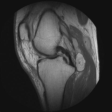 71-year-old female with lipoma arborescens. Coronal T1-weighted MRI of... | Download Scientific ...