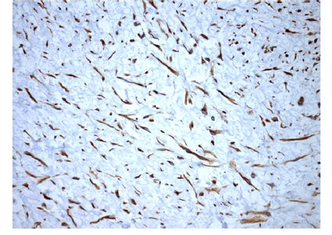 Odontogenic Myxoma Histology