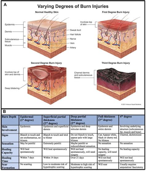 Image result for burn depth 1-4 | Subcutaneous tissue, Burn injury, Burns