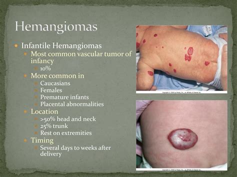 PPT - Hemangiomas and Vascular Malformations PowerPoint Presentation, free download - ID:780098