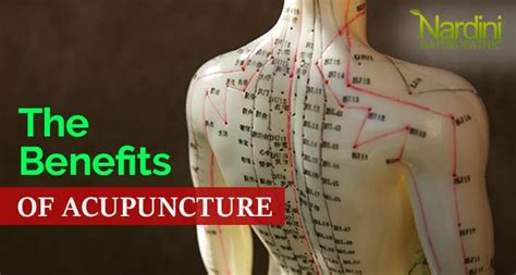 The Benefits Of Acupuncture | Dr. Pat Nardini, Naturopathic Doctor | Naturopathic Doctor in Toronto