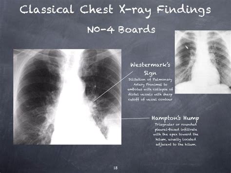 Pulmonary Embolism | Pulmonary embolism, Pulmonary, Radiography