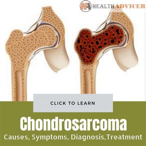 Chondrosarcoma: Causes, Symptoms, Diagnosis And Treatment