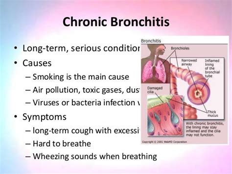 chronic bronchitis causes - DriverLayer Search Engine