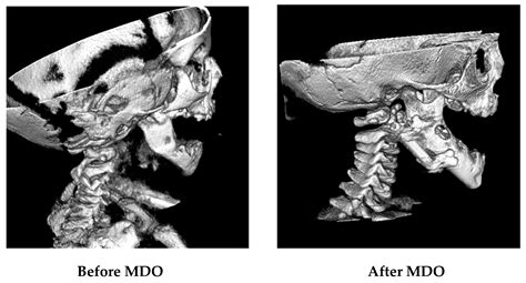 Complications of Mandibular Distraction Osteogenesis in Infants with ...