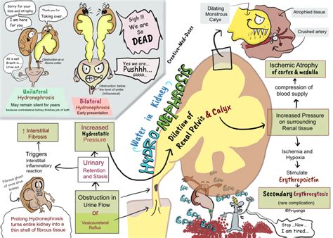 Hydronephrosis: Dilated Pelvis and calyx - Creative Med Doses