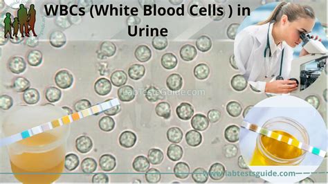 WBCs (White Blood Cells ) in Urine | Lab Tests Guide