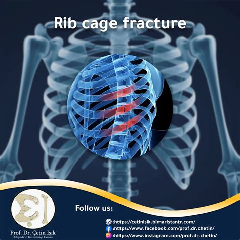 Fracture of the rib cage - ways to treat it without surgery - Dr. What's wrong with you?