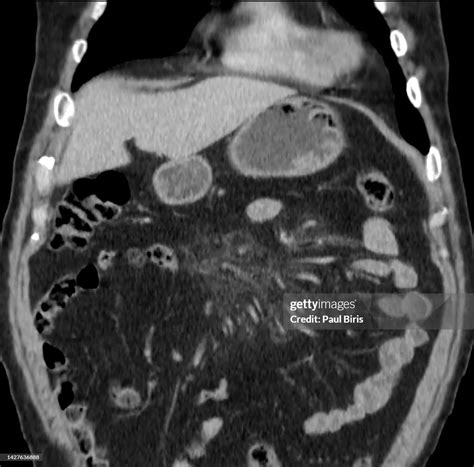 Ct Findings In Sclerosing Mesenteritis Coronal View High-Res Stock ...