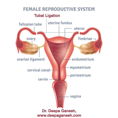 Tubal Ligation – Another birth control method | Dr. Deepa Ganesh