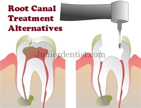 5 Alternative Treatments to Root canal