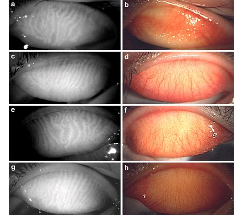 a-h Representative meibography results. a An image with meibography and ...