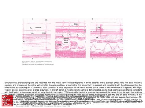 Simultaneous phonocardiograms are recorded with the mitral valve ...