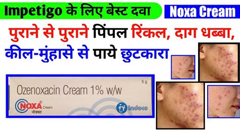 Noxa Cream/ Ozenoxacin cream review in hindi / Noxa cream Uses, Dose, Side effect / Ozenoxacin ...