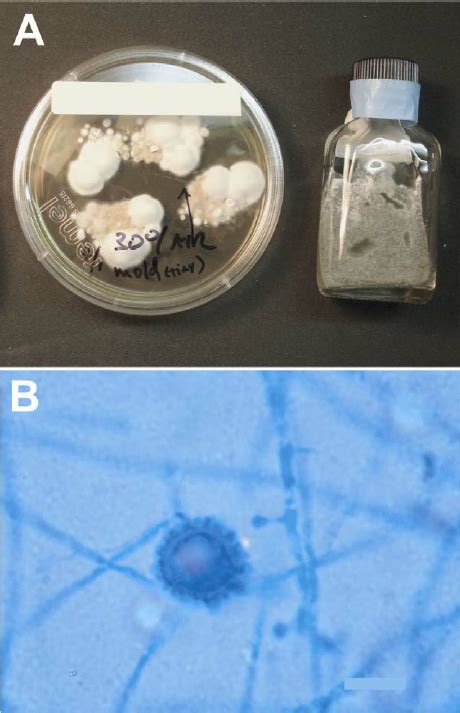 Cerebrospinal fluid (CSF) culture result. A, On the left is shown a... | Download Scientific Diagram