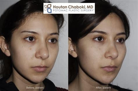 Fill Flat Cheeks with Facial Fillers