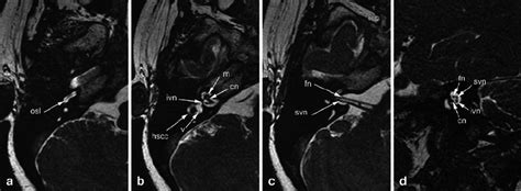 Normal inner ear anatomy on 3-D FIESTA MR image of the right temporal... | Download Scientific ...