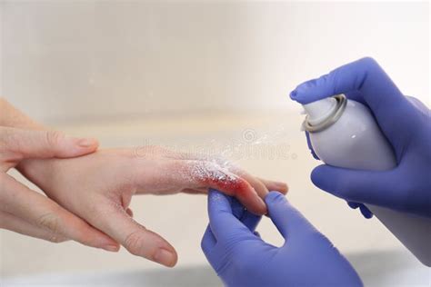 Applying Burn Spray Onto Injured Skin, Closeup Stock Photo - Image of applying, adult: 211329524