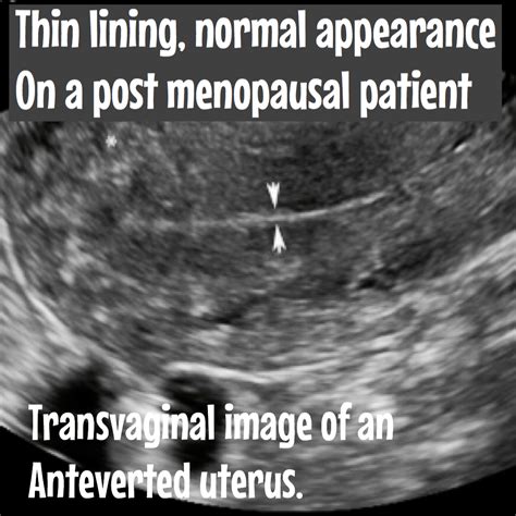 Endometrial hyperplasia. Ultrasound included. - Ultrasoundfeminsider