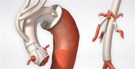 Terumo Aortic Vascular Grafts : Products : Terumo Cardiovascular Systems