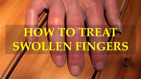 What To Do For Swollen Fingers