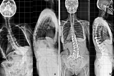 Spinal Diseases as related to Spine - Pictures