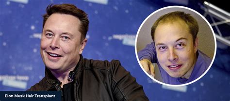 Elon Musk Hair Transplant 2023 - Smile Hair Clinic