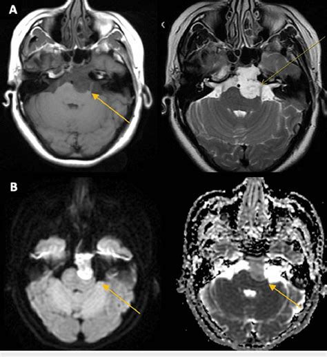 An MRI of the brain demonstrates a lesion of the prepontine cistern... | Download Scientific Diagram