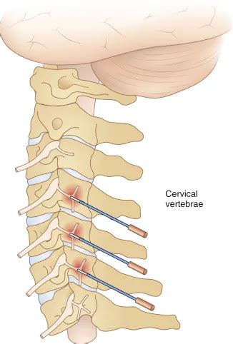 Cervical Arthropathy - Spine Surgeon - Antonio Webb, MD