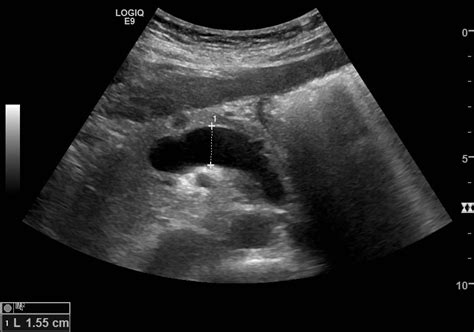 Ultrasound Case 045 • LITFL • POCUS Self-Assessment Quiz