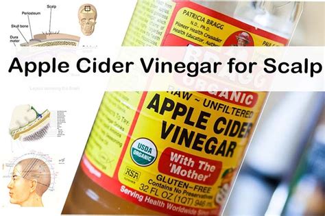 Apple Cider Vinegar for Dry Itchy Scalp and Psoriasis Treatment