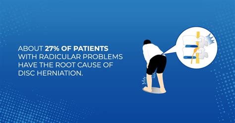 Radicular Pain | Signs And Symptoms | Treatment | J.Flowers