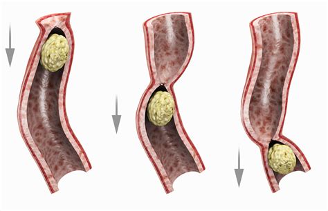 An ileus is a common complication of abdominal surgery where the normal muscle contractions of ...