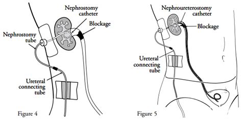 Caring for Your Nephrostomy Catheter | Memorial Sloan Kettering Cancer ...