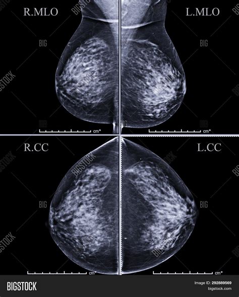 Digital Mammogram Both Image & Photo (Free Trial) | Bigstock