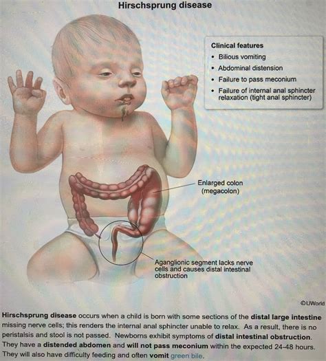 Hirschsprung Disease Newborn Nursing, Child Nursing, Nursing Study, Nursing Students, Postpartum ...