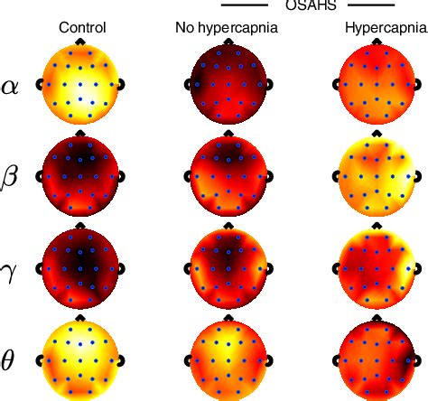 Figure 1 from Diurnal EEG Alterations in Obstructive Sleep Apnea ...