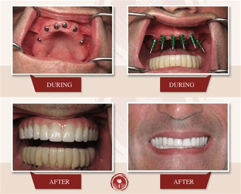 Prettau Dental Implant Full Mouth Bridge | Alternative to All-on-4 | Ramsey A. Amin, DDS