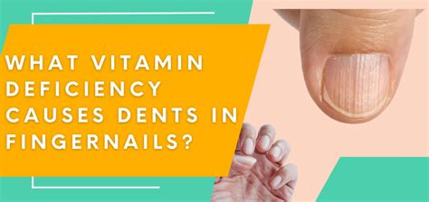 What Vitamin Deficiency Causes Dents In Fingernails? - Drug Genius