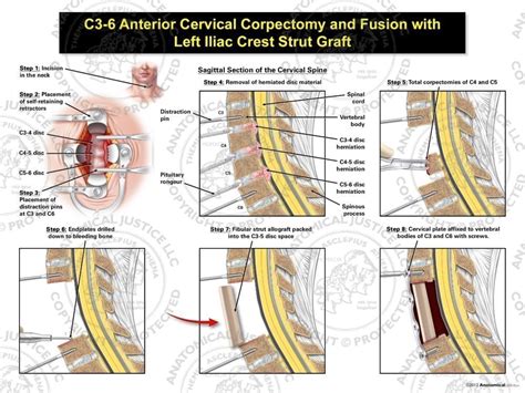 C3-6 Anterior Cervical Corpectomy and Fusion with Fibular Strut Graft