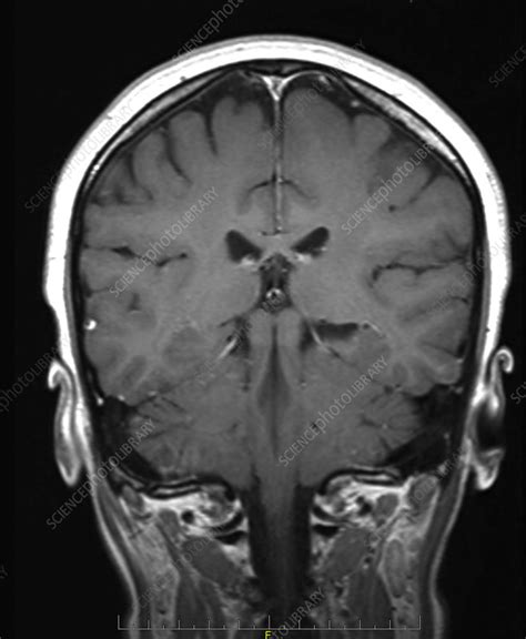 Superior temporal sulcus, MRI - Stock Image - C039/3592 - Science Photo Library